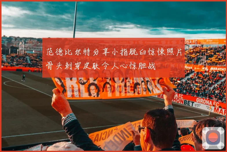范德比尔特分享小指脱臼惊悚照片骨头刺穿皮肤令人心惊胆战